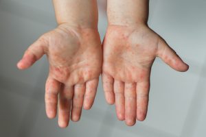 Mitos e verdades sobre o sarampo
